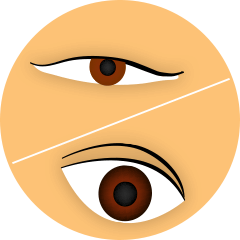 眼瞼下垂/二重手術